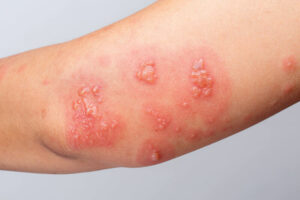 ingrown hair vs herpes