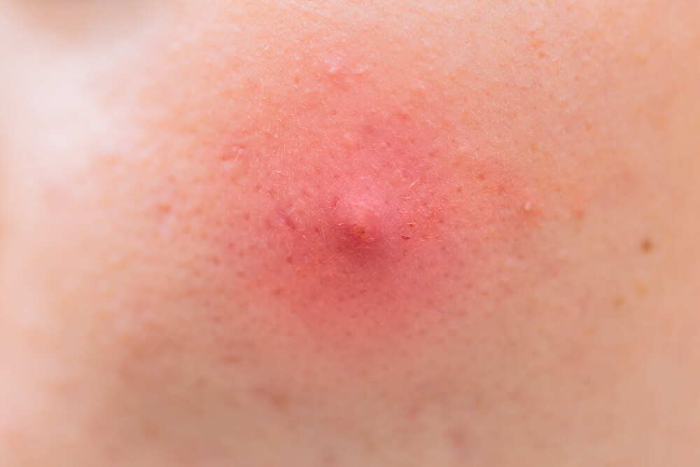 pimple on penis