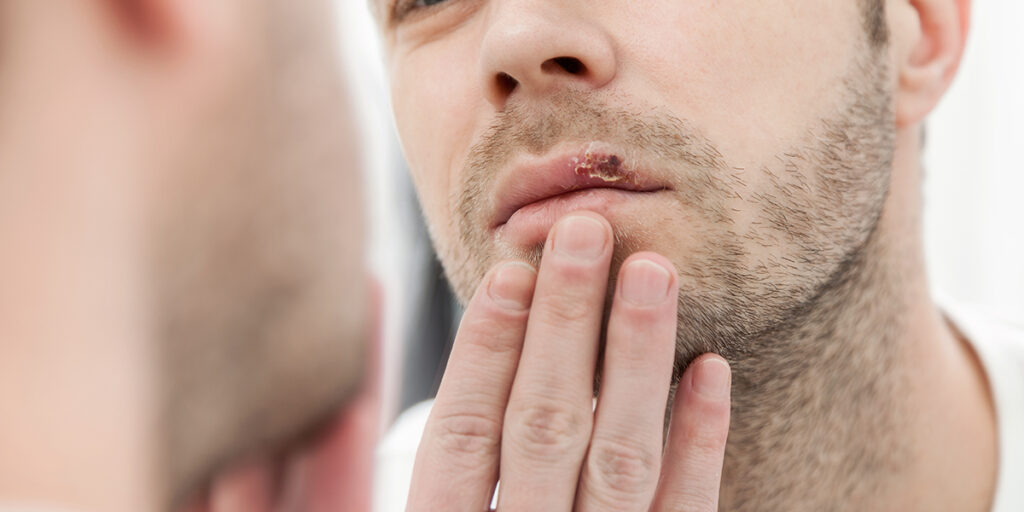 do cold sores mean you have an std