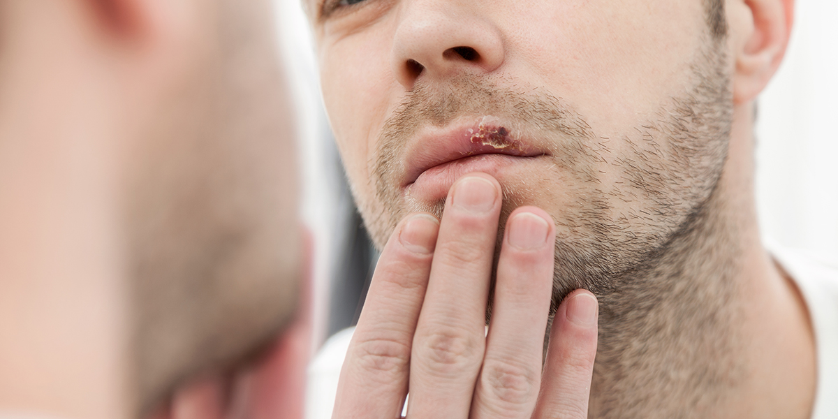 Do Cold Sores Mean You Have An STD Rapid STD Testing