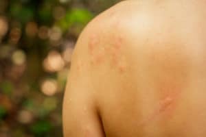 jock itch or herpes
