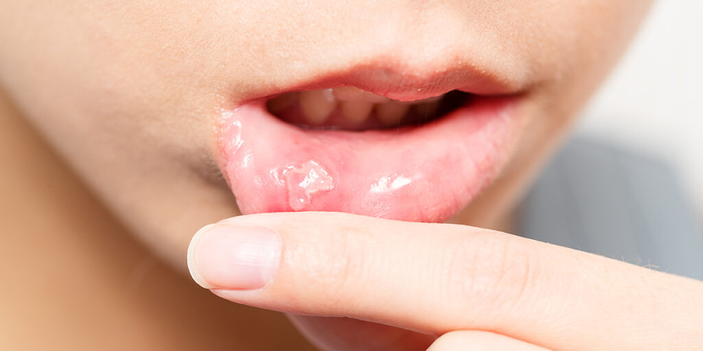 what are fordyce spots