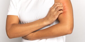 stds that cause dry skin