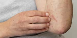 is scabies an std