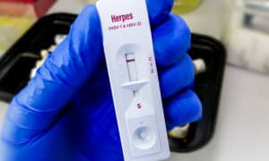 how long does a herpes test take