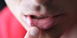 " what to know about herpes all about herpes"