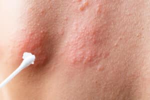 Herpes