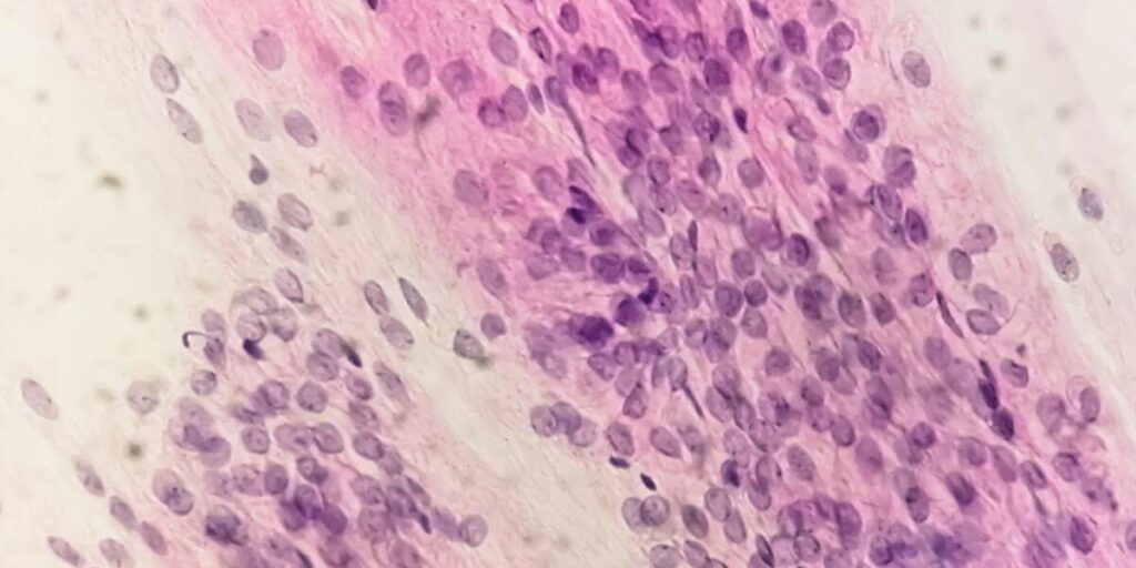 can trichomoniasis cause hiv