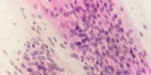 can trichomoniasis cause hiv