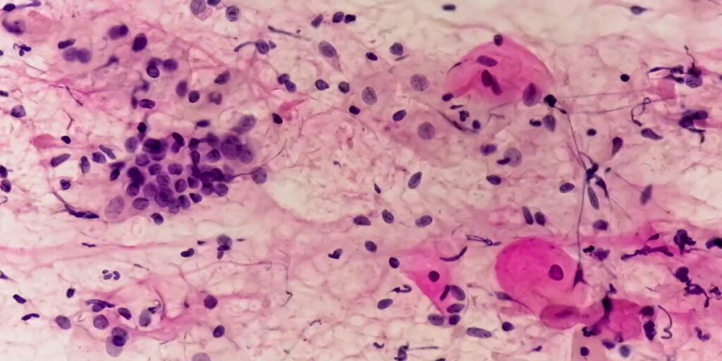 does hpv cause recurrent yeast infections