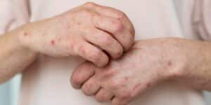herpes scars