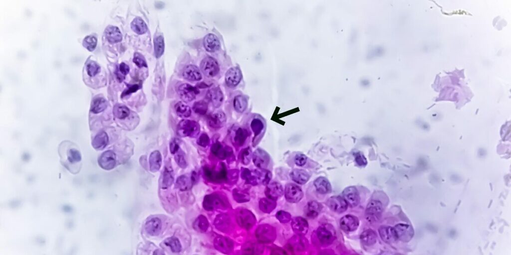 how long does trichomoniasis last