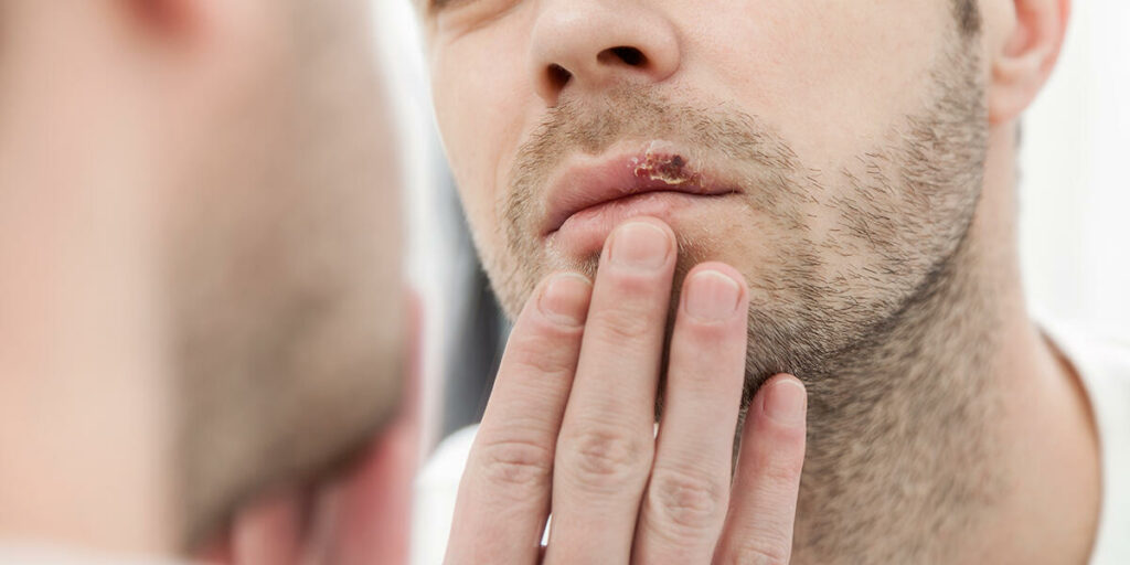 can herpes turn into hiv