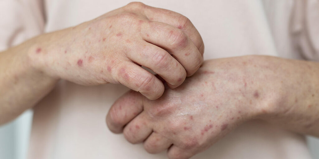 can you pass syphilis without a sore